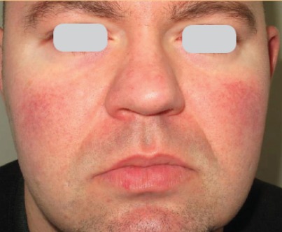 Rosacea What to do ? 