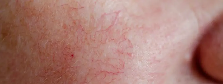 Rosacea face