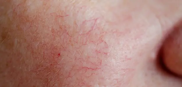 The Four Stages of Rosacea | Pulse Light Clinic London