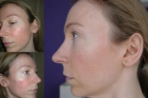 Before and after IPL rosacea treatments