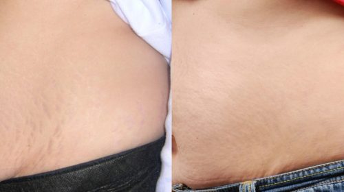 stretch mark removal