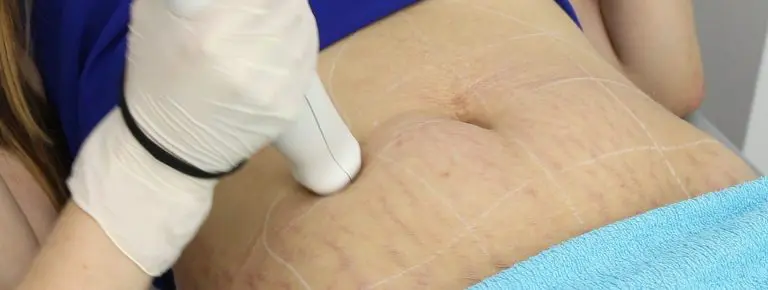 Stretch Mark Removal