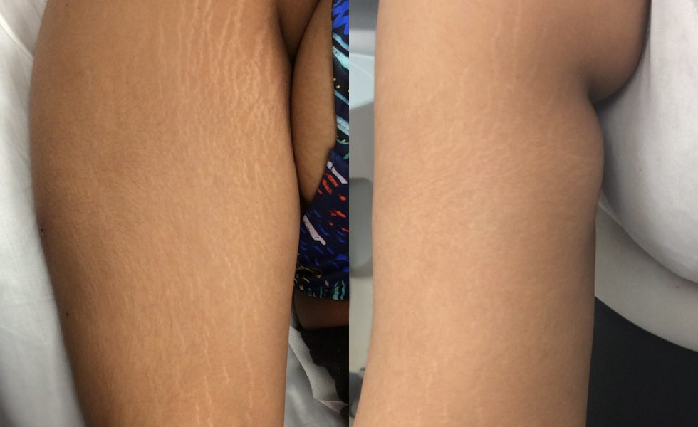 Picture of a lady's before and after receiving stretch mark removal