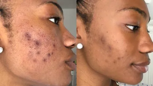 Dermapen acne scar treatment