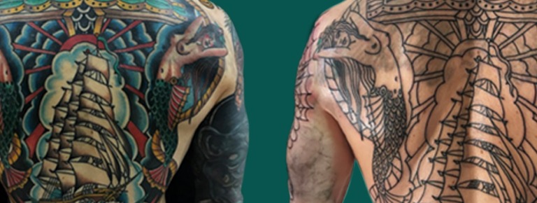 Tattoo Removal London Mobile Graphic
