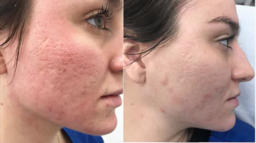 Image result for Laser Acne Treatment