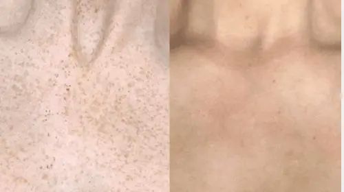 After 4 Freckle Removal Picosure Treatments