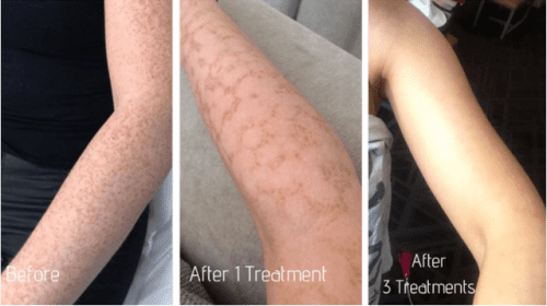 After 4 Freckle Removal PicoSure Treatments
