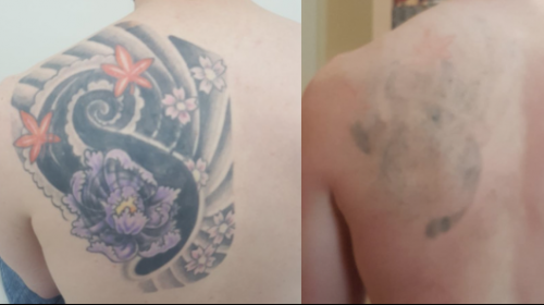 After 7 Laser Tattoo Removal PicoWay Treatments