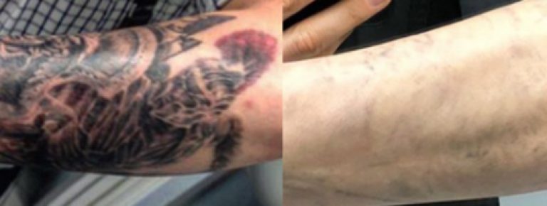 Laser Tattoo Removal Cover Up