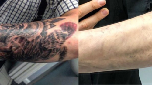 Laser Tattoo Removal Cover Up