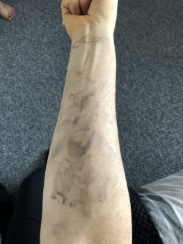 Arm after tattoo removal example