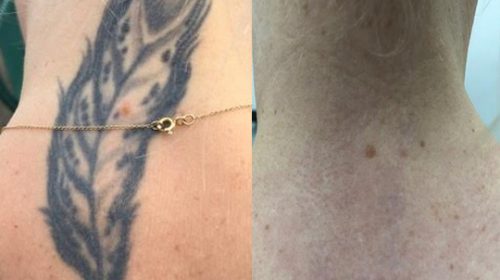 After 4 Laser Tattoo Removal PicoWay Treatments