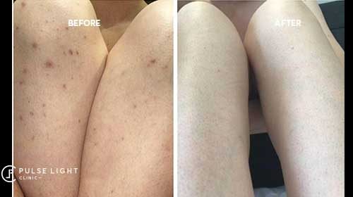 Ingrown hairs removal before and after