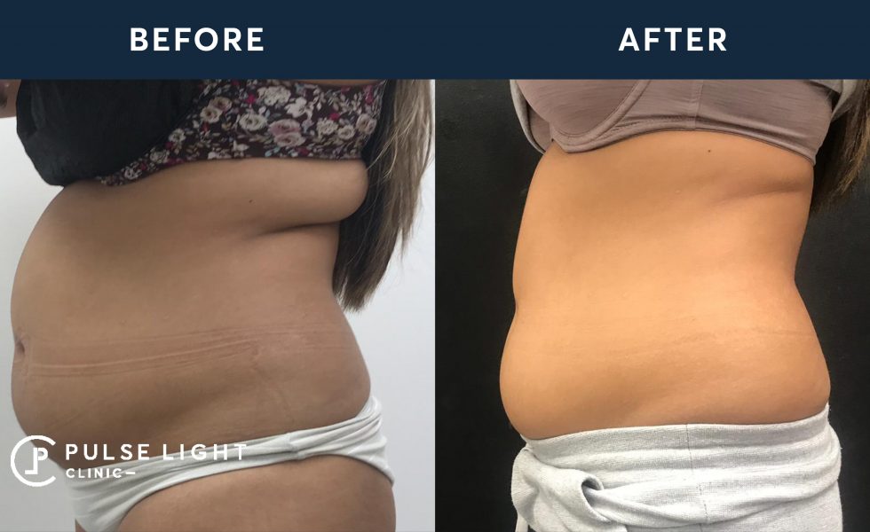 After 1 CoolSculpting treatment, with 4 applicators on abdomen & 2 on flanks.