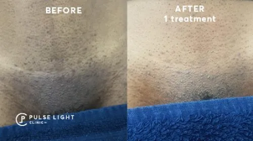 Hollywood laser shop hair removal