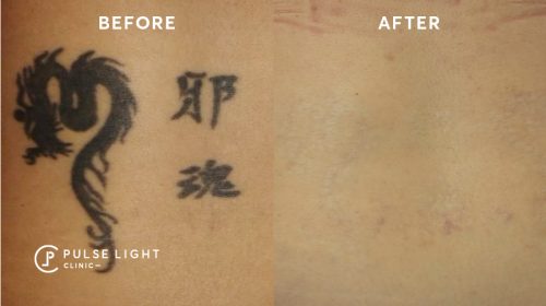 After 5 Laser Tattoo Removal PicoWay Treatments