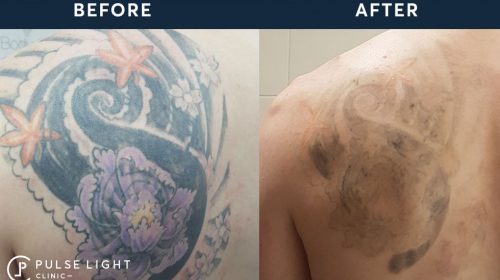 PicoSure Tattoo Removal | Pulse Light Clinic London PicoSure Tattoo Removal | Pulse Light Clinic London