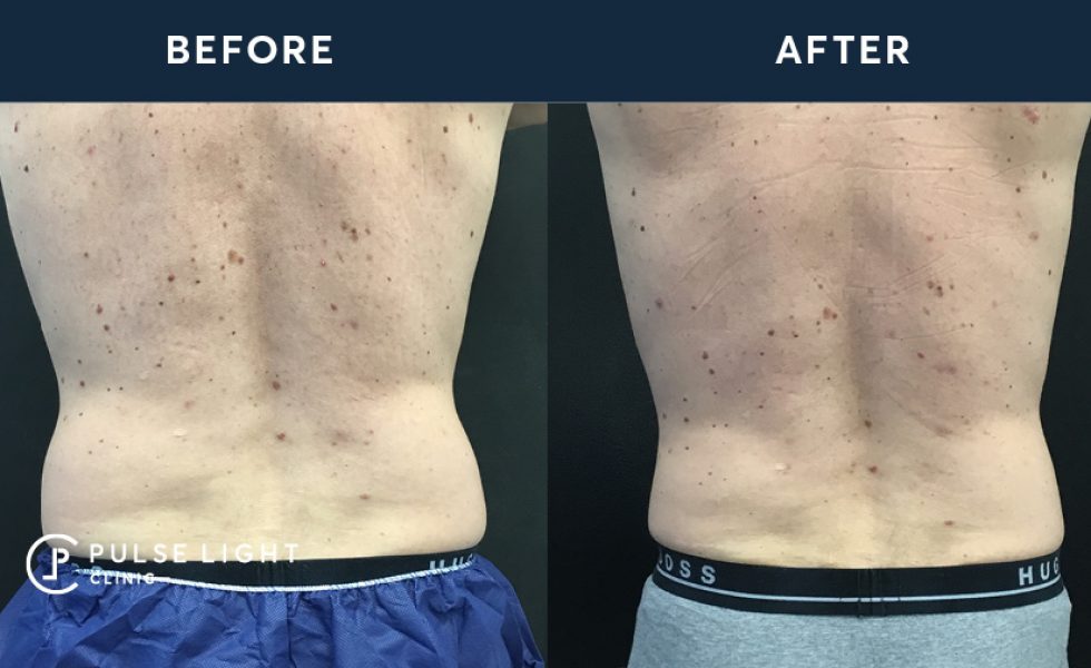 After 1 CoolSculpting treatment, with 2 applicators on flanks