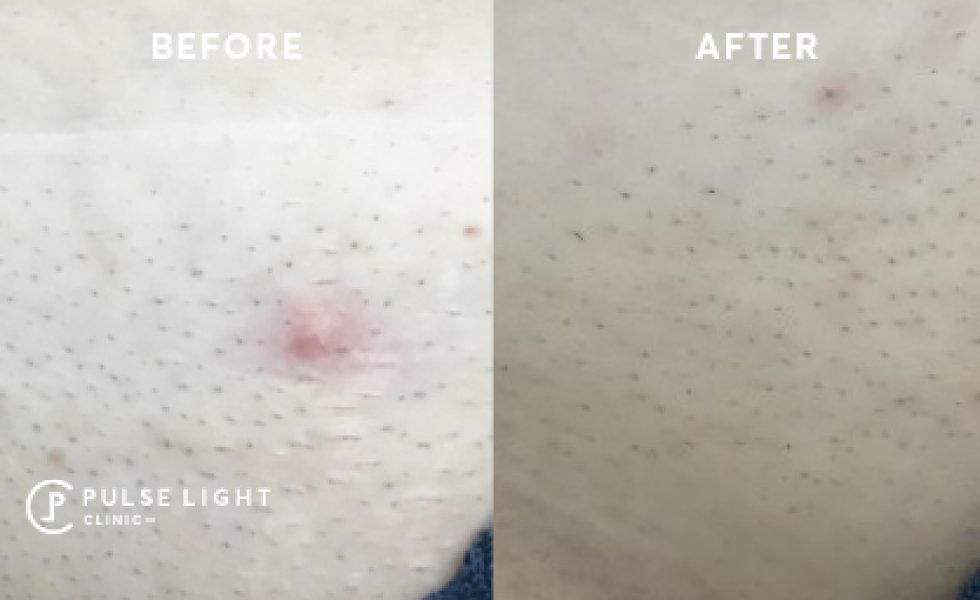 Before and after bikini laser hair removal