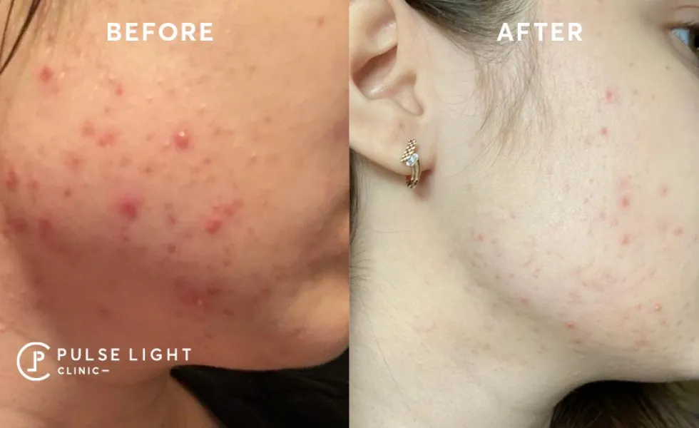 Icon Acne Scar treatments