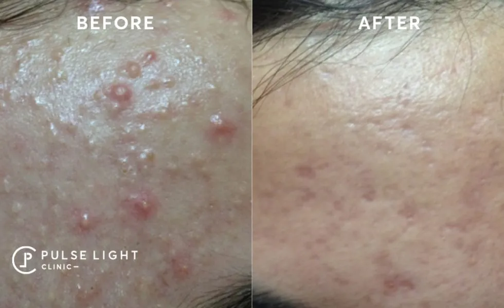 After 1 Icon AcneScar treatment