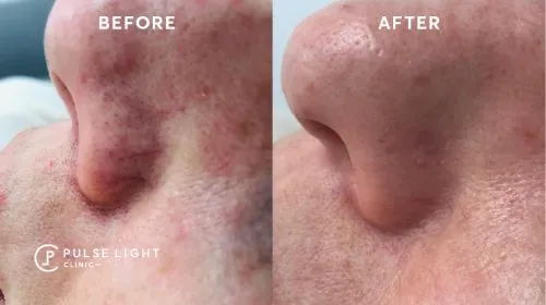 IPL Rosacea Treatment