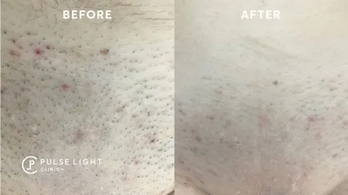 Laser hair removal before and after 激光脱毛 前后对比