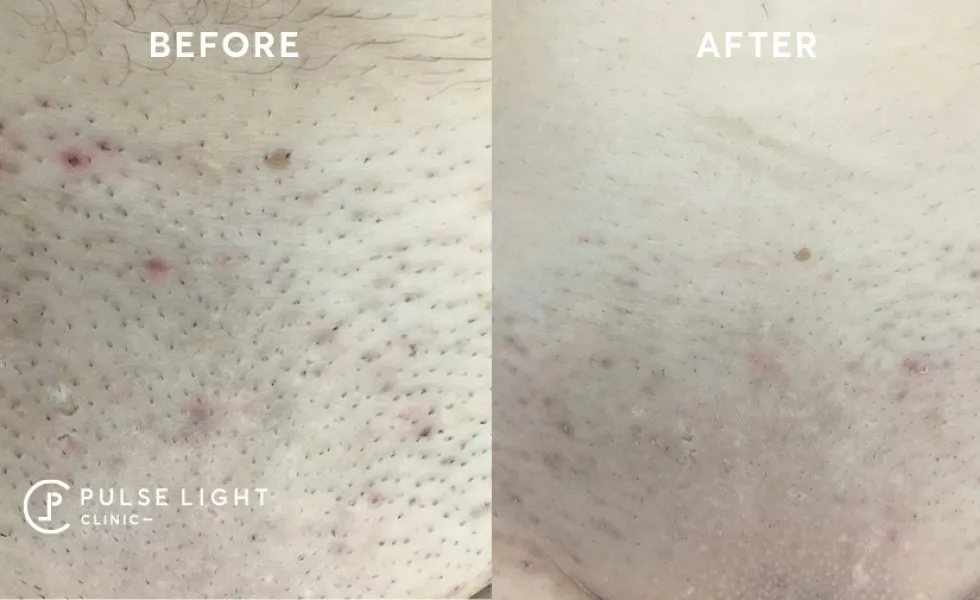 Brazilian Laser Hair Removal for Women  VS MedSpa Laser Clinic