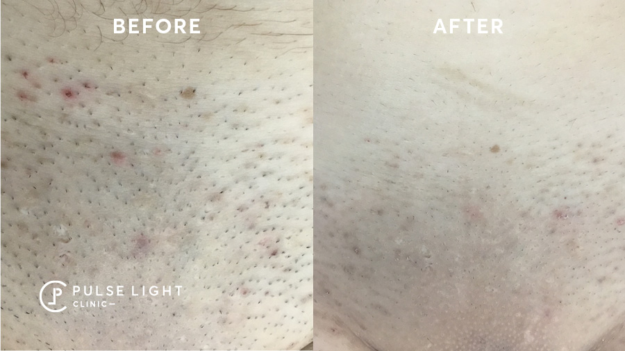Hollywood Bikini Laser Hair Removal Before and After 激光脱毛 前后对比