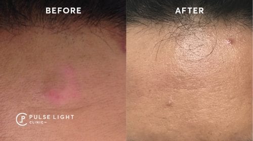 Melasma Pigmentation Laser Treatment