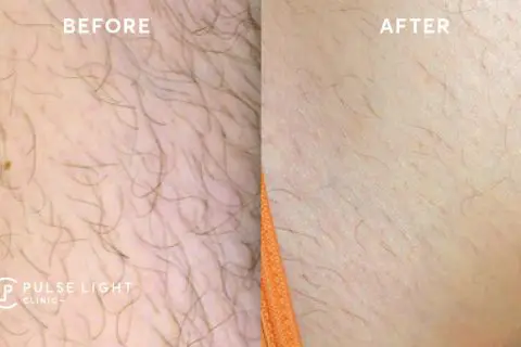Why You Should Opt For Laser Hair Removal Pulse Light Clinic London