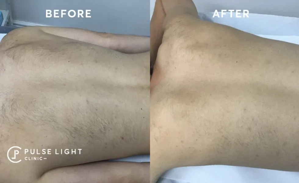 Laser Hair Removal Men Pulse Light Clinic London