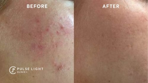 Acne before and after on cheeks