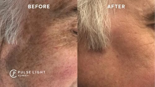 Before and after of a man after having PicoSure treatment to reduce his wrinkles