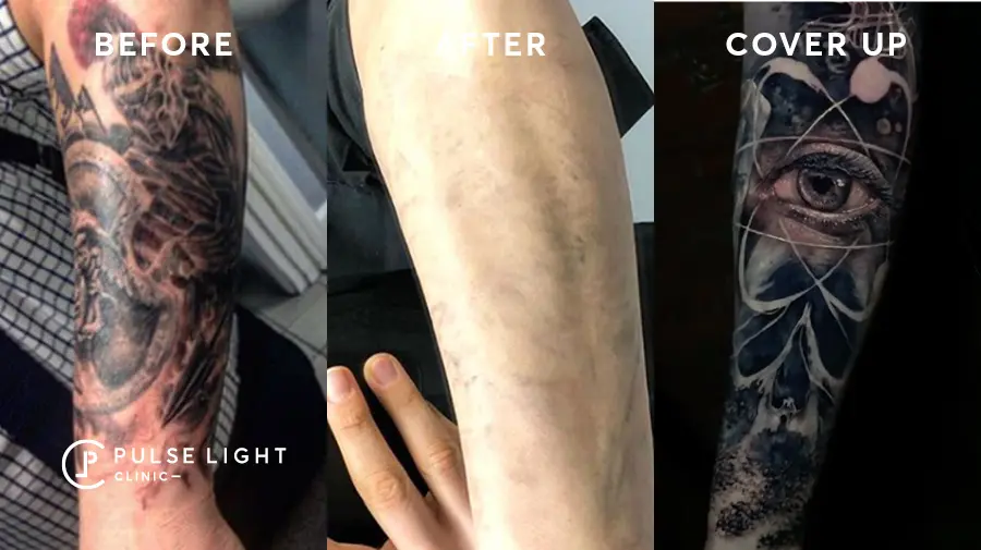 Cover up Vs. Laser Tattoo Removal