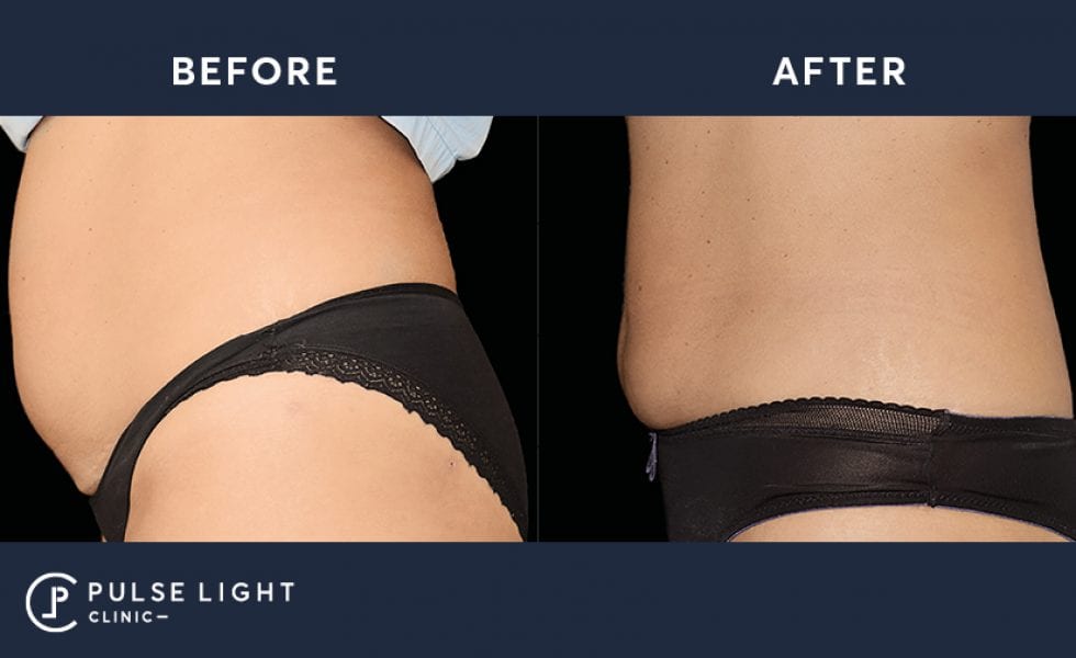 Before and after taken of a woman's abdomen using Emsculpt