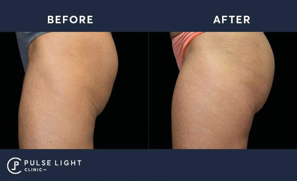 Emsculpt bum lift