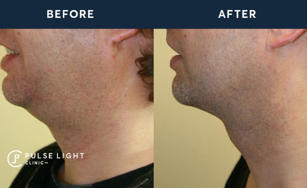 Before and after treatment of a man's face after Profound treatment at Pulse Light Clinic