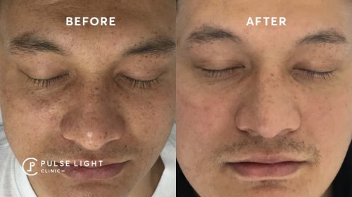 After 1 pigmentation treatment of a man's face