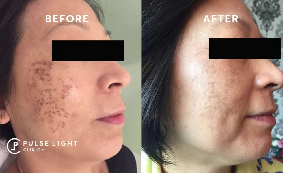 A lady's face with pigmentation before getting hydra facial treatment