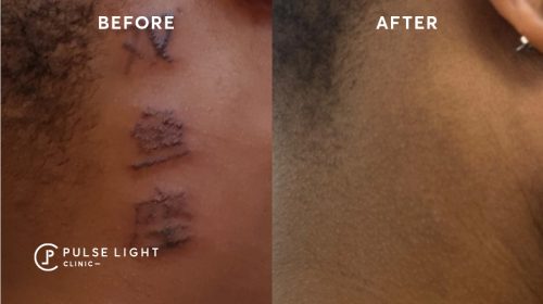 Laser tattoo removal before and after on dark skin model