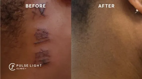 Tattoo Removal  OTM Skin