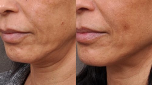 Anti ageing before and after