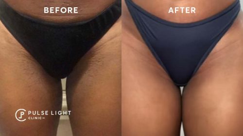 Before and after bikini laser hair removal treatments at Pulse Light Clinic