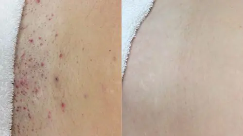 Bikini Hair Removal