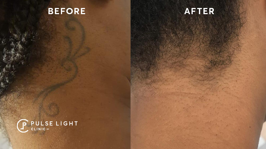 Before and after laser tattoo removal on dark skin