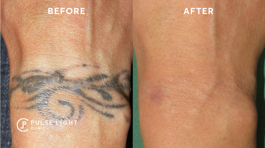 Revlite tattoo removal machine before and after