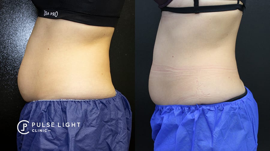 CoolSculpting for Stomach, Belly Fat & Abs , CoolSculpting vs Liposuction