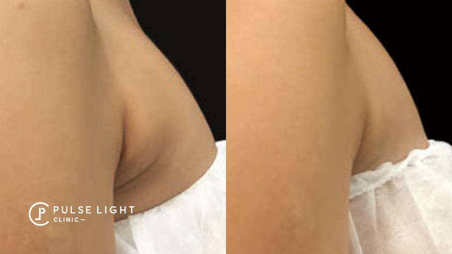 Before and after fat removal on lady's bra fat